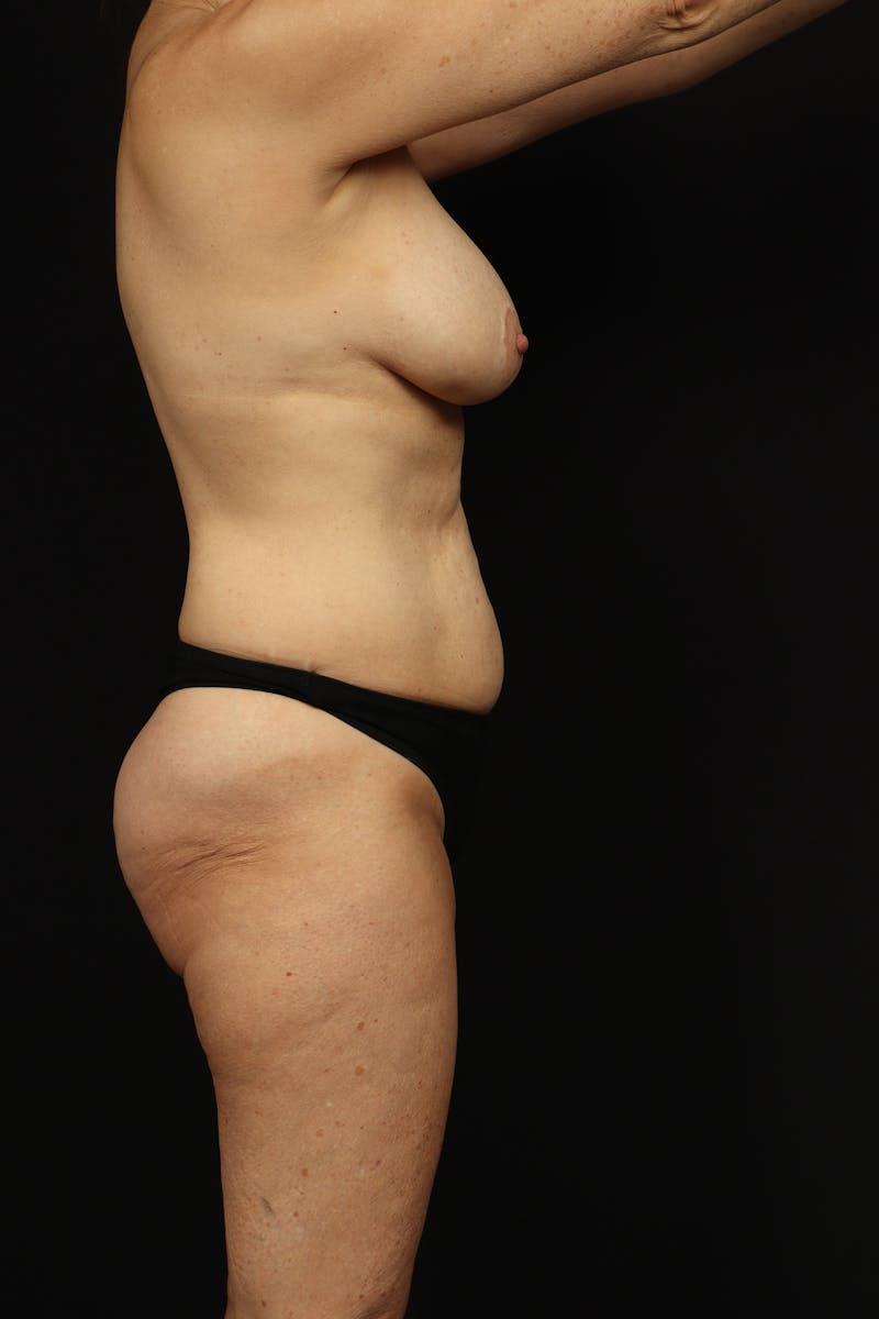 Mastopexy Before & After Gallery - Patient 780616 - Image 11