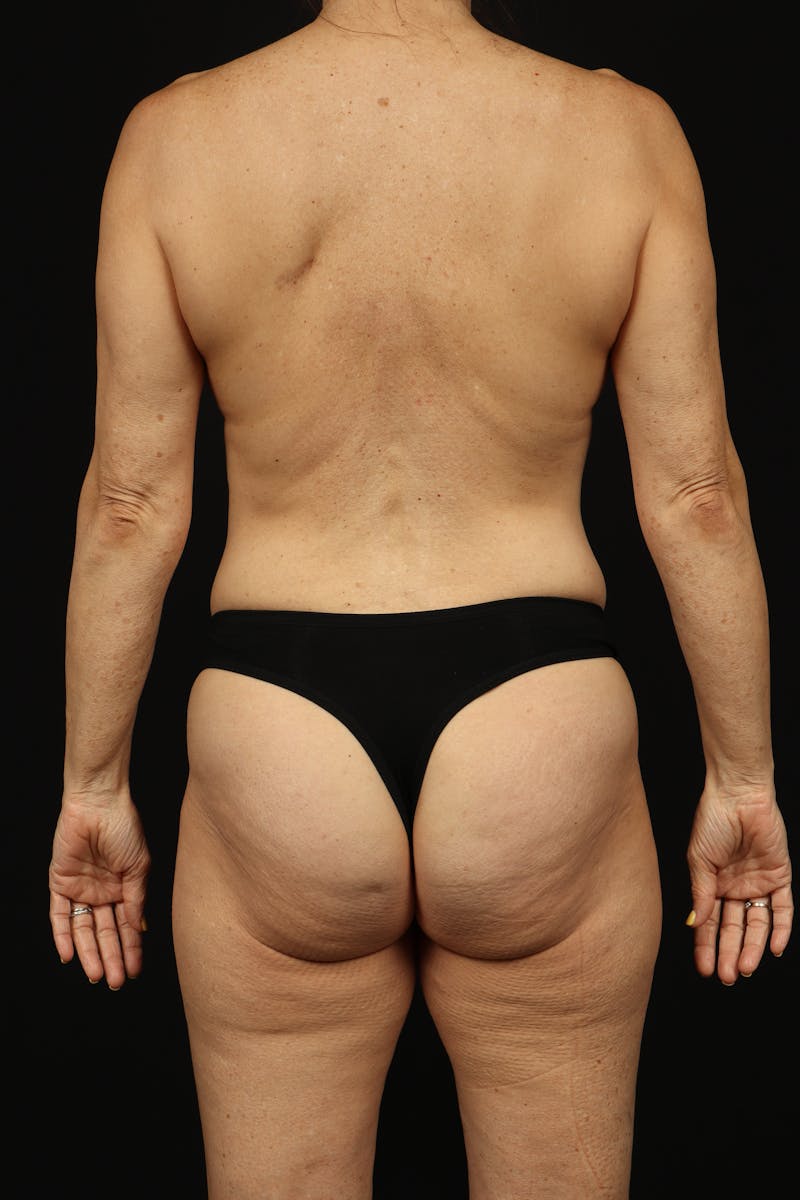 Mastopexy Before & After Gallery - Patient 780616 - Image 7