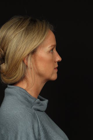 Blepharoplasty Before & After Gallery - Patient 954717 - Image 10