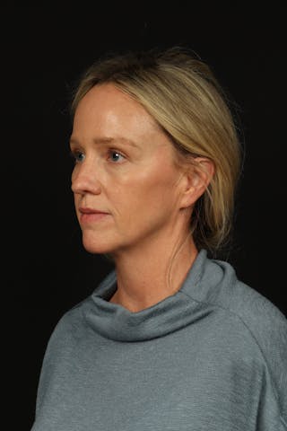 Blepharoplasty Before & After Gallery - Patient 954717 - Image 4