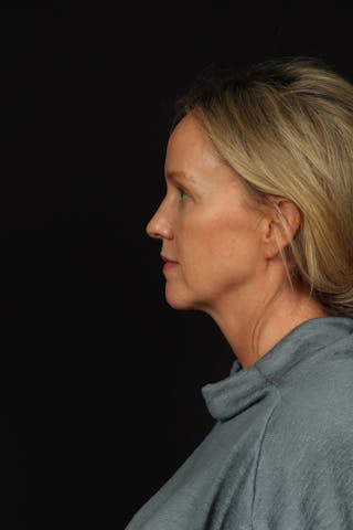 Blepharoplasty Before & After Gallery - Patient 954717 - Image 6