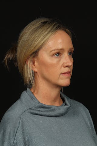 Blepharoplasty Before & After Gallery - Patient 954717 - Image 8