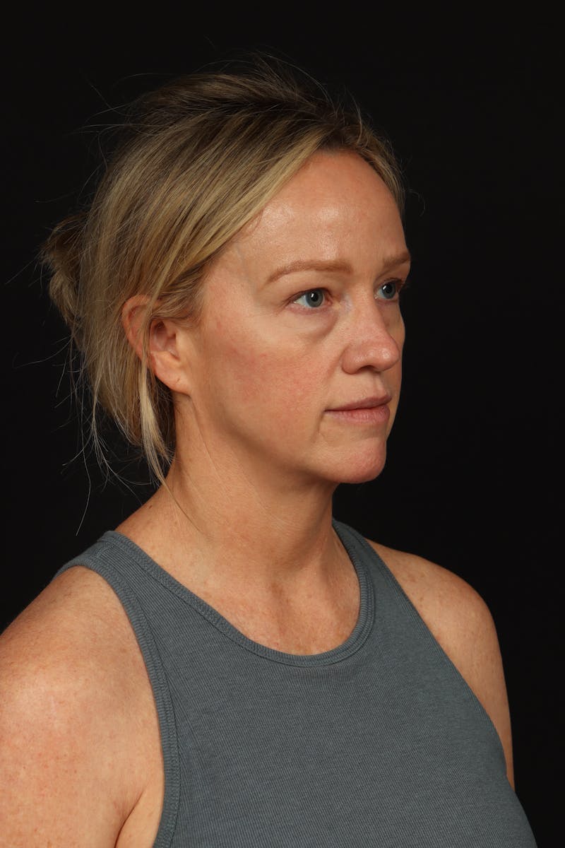 Blepharoplasty Before & After Gallery - Patient 954717 - Image 7