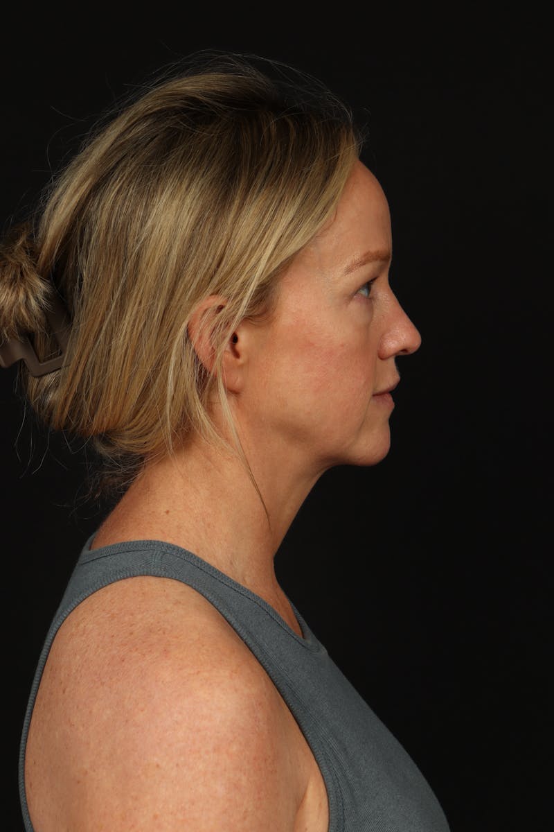 Blepharoplasty Before & After Gallery - Patient 954717 - Image 9