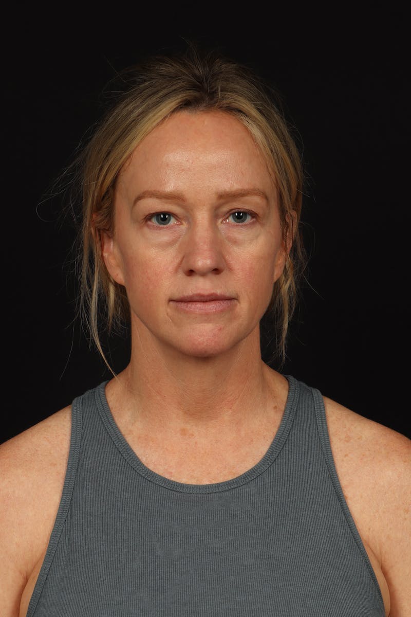 Blepharoplasty Before & After Gallery - Patient 954717 - Image 1