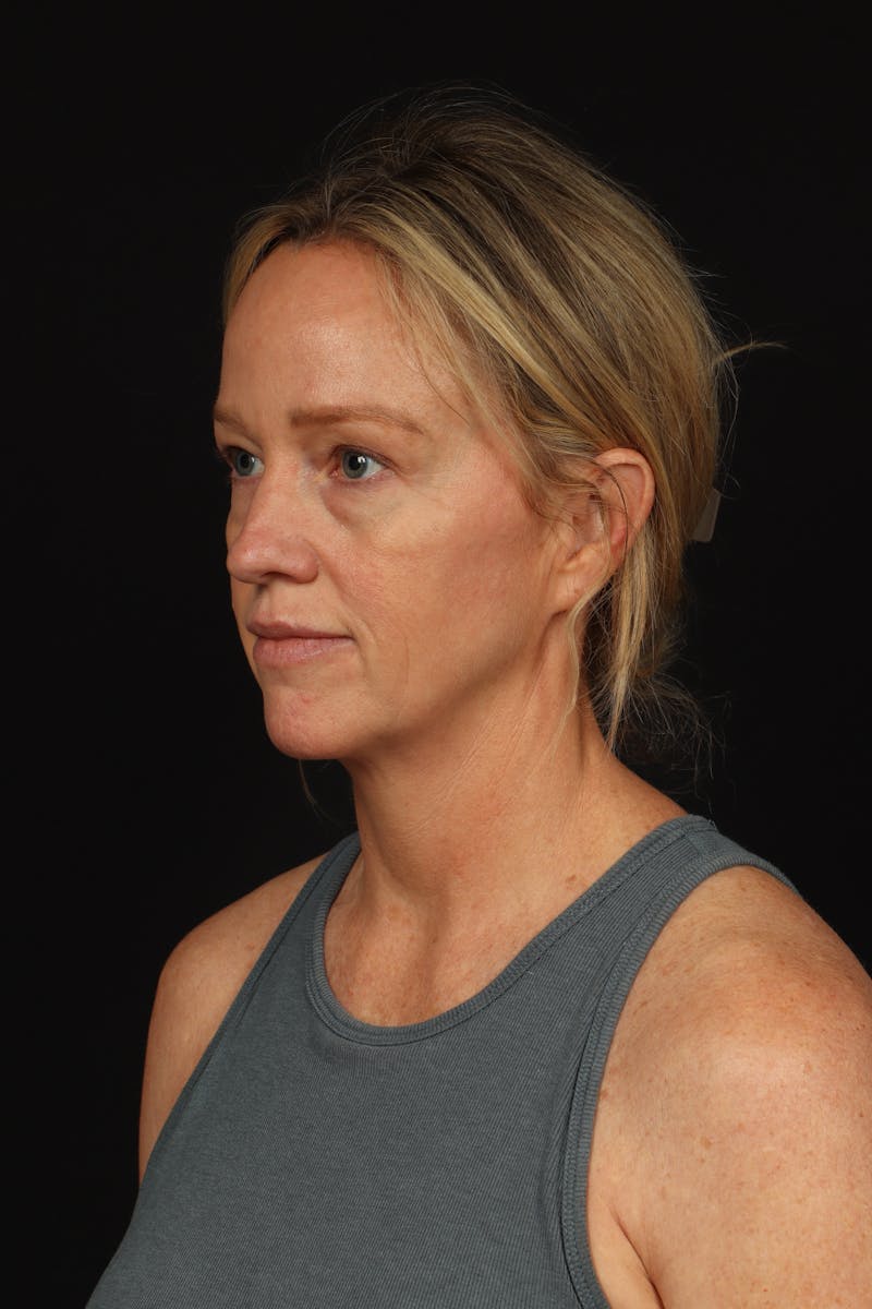 Blepharoplasty Before & After Gallery - Patient 954717 - Image 3