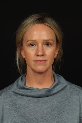 Blepharoplasty Before & After Gallery - Patient 954717 - Image 2