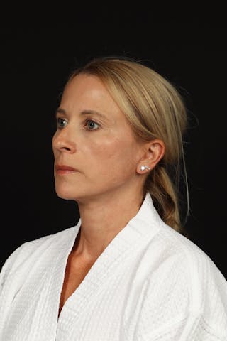 Facelift Before & After Gallery - Patient 374058 - Image 4