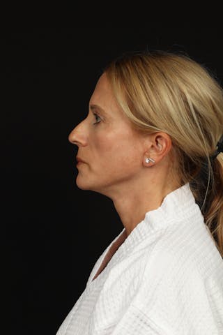 Facelift Before & After Gallery - Patient 374058 - Image 6