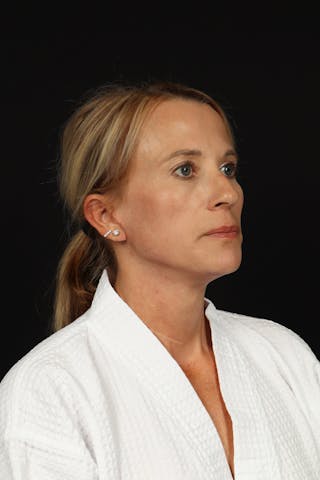 Facelift Before & After Gallery - Patient 374058 - Image 8