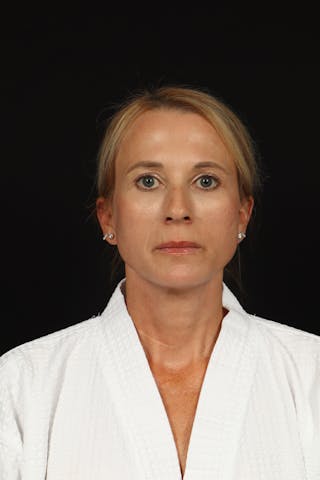 Facelift Before & After Gallery - Patient 374058 - Image 2