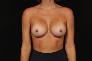 Breast Augmentation Silicone Gel Before & After Gallery - Patient 252521 - Image 2