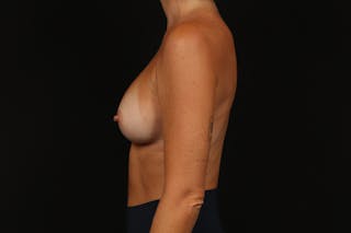 Breast Augmentation Silicone Gel Before & After Gallery - Patient 252521 - Image 6