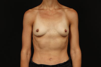 Breast Augmentation Silicone Gel Before & After Gallery - Patient 288442 - Image 1