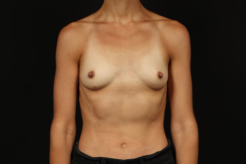 Breast Augmentation Silicone Gel Before & After Gallery - Patient 288442 - Image 1