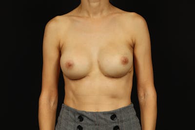 Aesthetic Breast Revision Before & After Gallery - Patient 189010 - Image 2