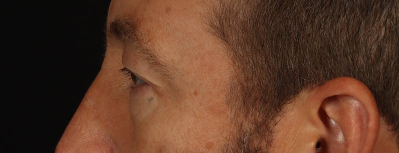 Blepharoplasty Before & After Gallery - Patient 117538 - Image 5