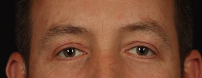 Blepharoplasty Before & After Gallery - Patient 117538 - Image 2
