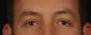 Blepharoplasty Before & After Gallery - Patient 117538 - Image 2