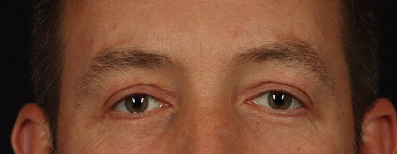 Blepharoplasty Before & After Gallery - Patient 117538 - Image 2