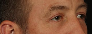 Blepharoplasty Before & After Gallery - Patient 117538 - Image 8