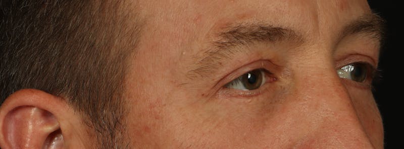 Blepharoplasty Before & After Gallery - Patient 117538 - Image 8