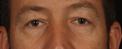 Blepharoplasty Before & After Gallery - Patient 117538 - Image 1