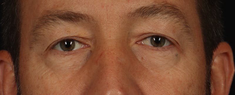 Blepharoplasty Before & After Gallery - Patient 117538 - Image 1