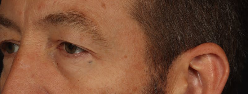 Blepharoplasty Before & After Gallery - Patient 117538 - Image 3
