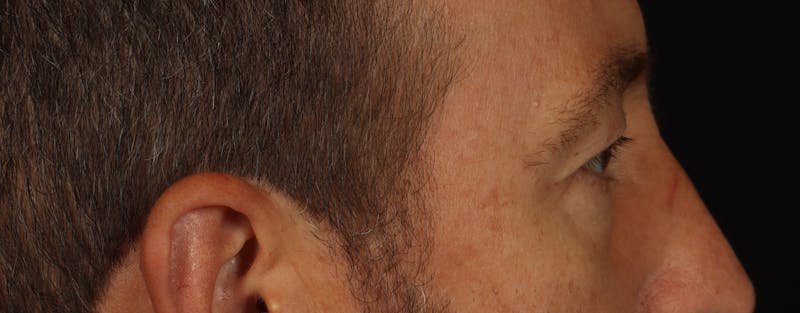 Blepharoplasty Before & After Gallery - Patient 117538 - Image 9