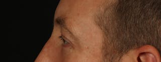 Blepharoplasty Before & After Gallery - Patient 117538 - Image 6