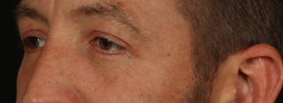 Blepharoplasty Before & After Gallery - Patient 117538 - Image 4