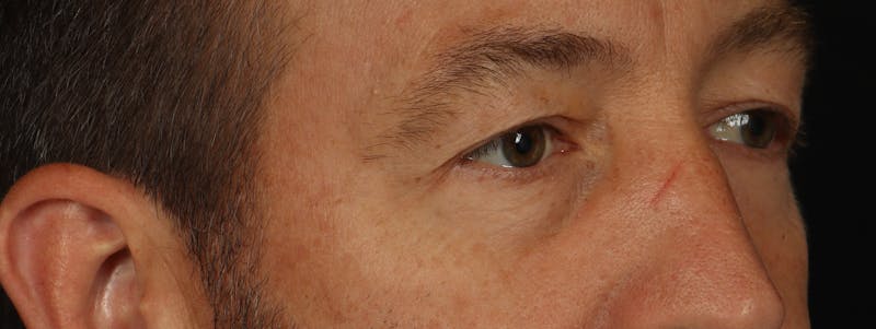Blepharoplasty Before & After Gallery - Patient 117538 - Image 7
