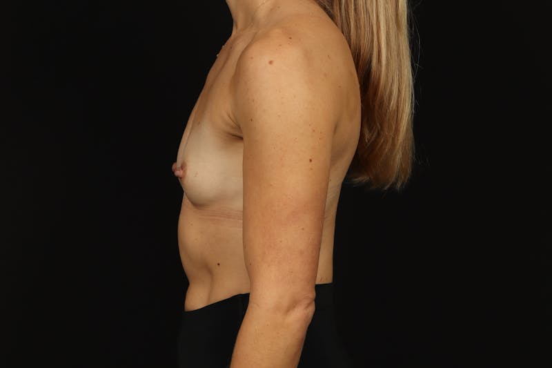 Breast Augmentation Silicone Gel Before & After Gallery - Patient 318267 - Image 5
