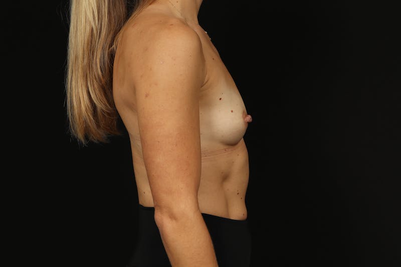 Breast Augmentation Silicone Gel Before & After Gallery - Patient 318267 - Image 9