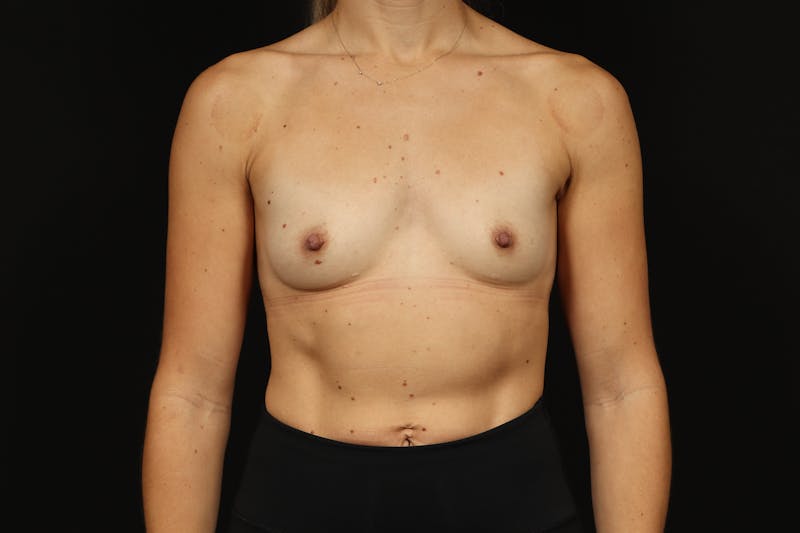 Breast Augmentation Silicone Gel Before & After Gallery - Patient 318267 - Image 1