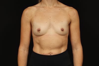 Breast Augmentation Silicone Gel Before & After Gallery - Patient 318267 - Image 1