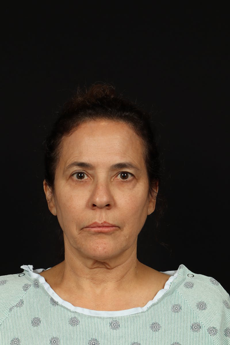 Facelift Before & After Gallery - Patient 343131 - Image 1