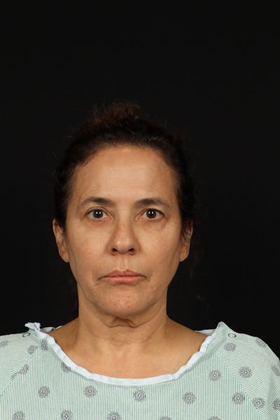 Facelift Before & After Gallery - Patient 343131 - Image 1