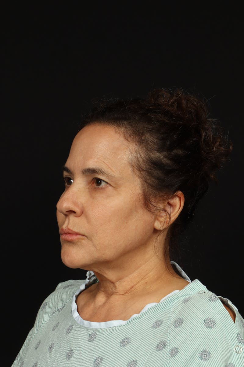 Facelift Before & After Gallery - Patient 343131 - Image 3