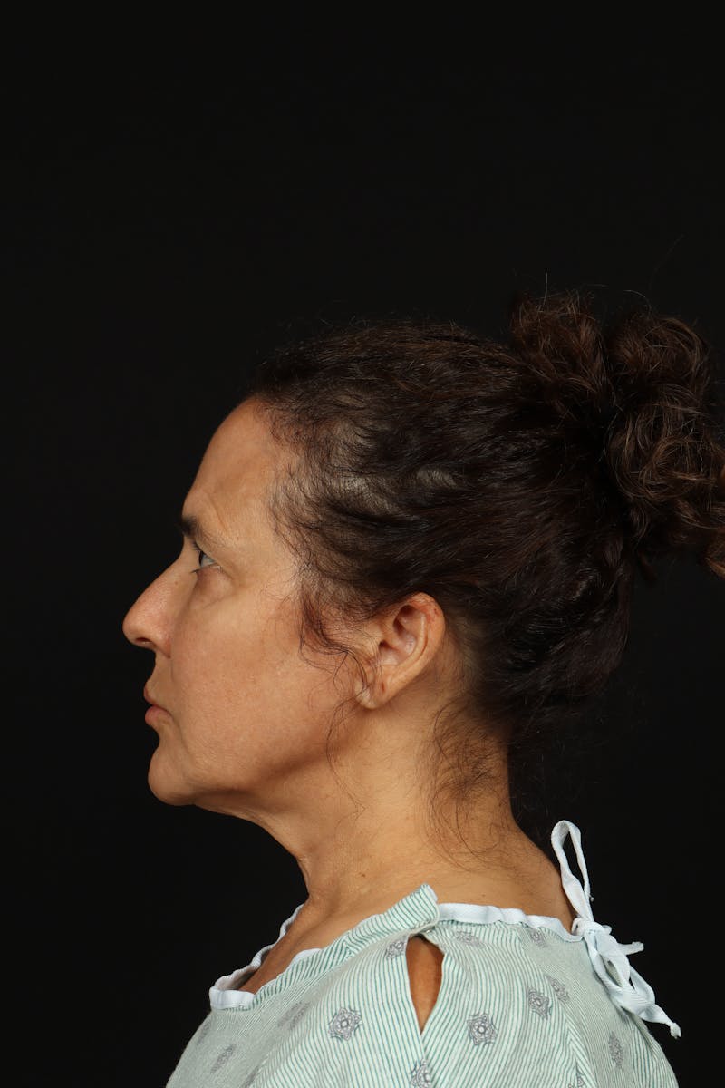 Facelift Before & After Gallery - Patient 343131 - Image 5