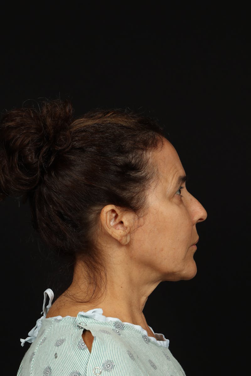 Facelift Before & After Gallery - Patient 343131 - Image 9