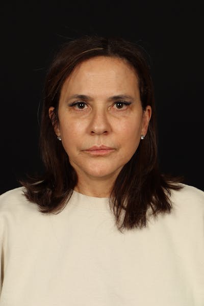 Facelift Before & After Gallery - Patient 343131 - Image 2