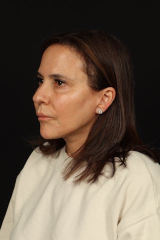 Facelift Before & After Gallery - Patient 343131 - Image 4