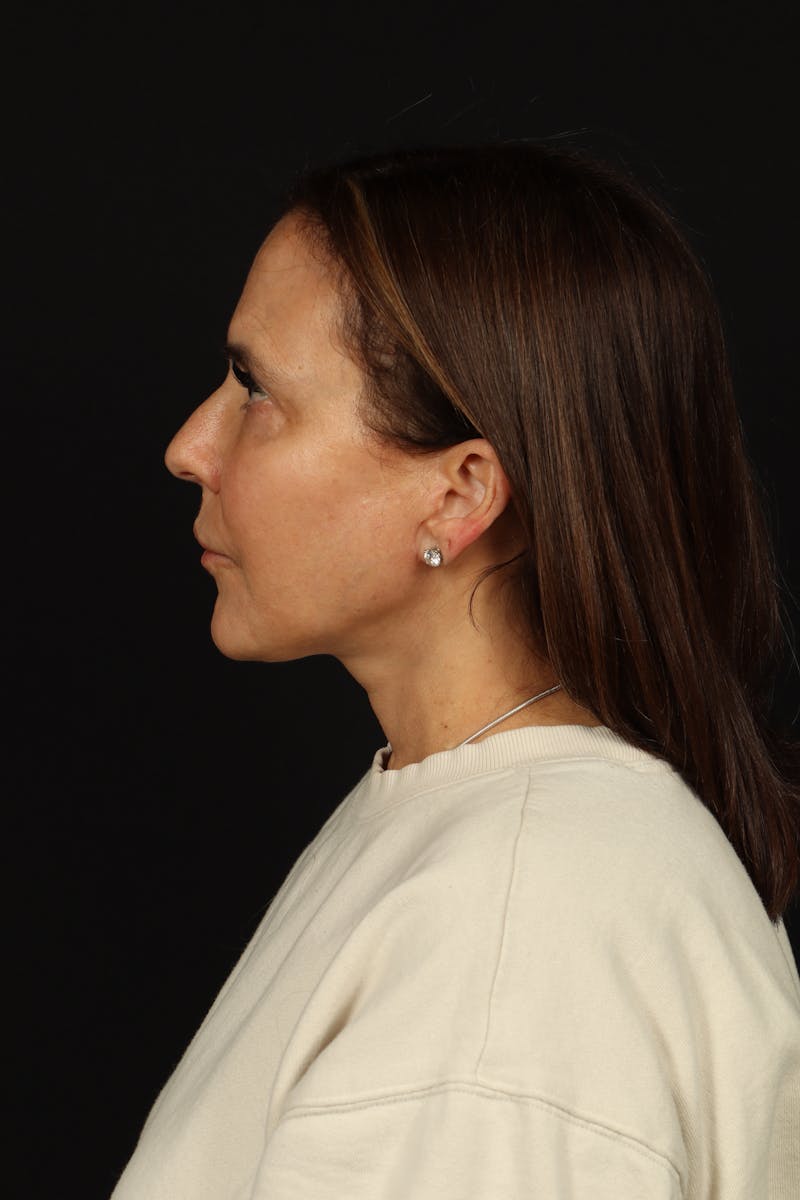 Facelift Before & After Gallery - Patient 343131 - Image 6