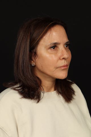 Facelift Before & After Gallery - Patient 343131 - Image 8