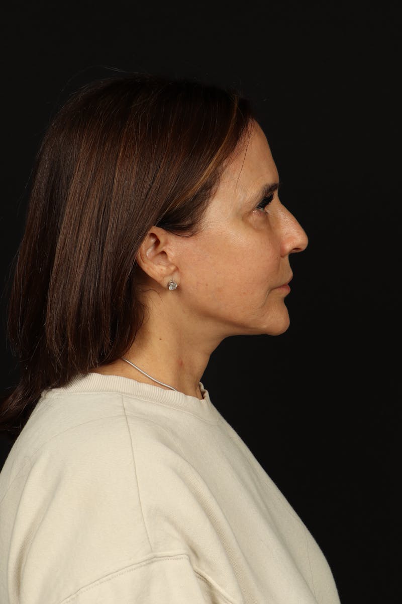 Facelift Before & After Gallery - Patient 343131 - Image 10