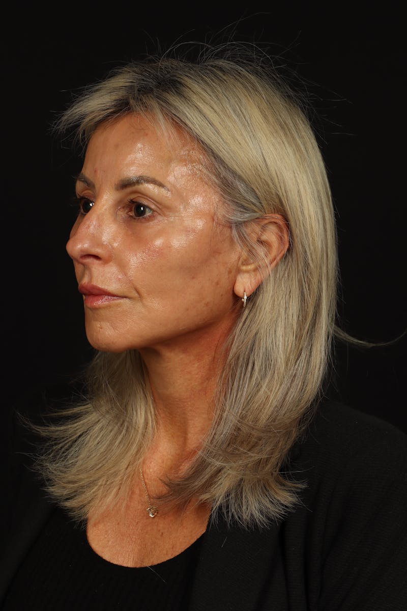 Facelift Before & After Gallery - Patient 246283 - Image 4