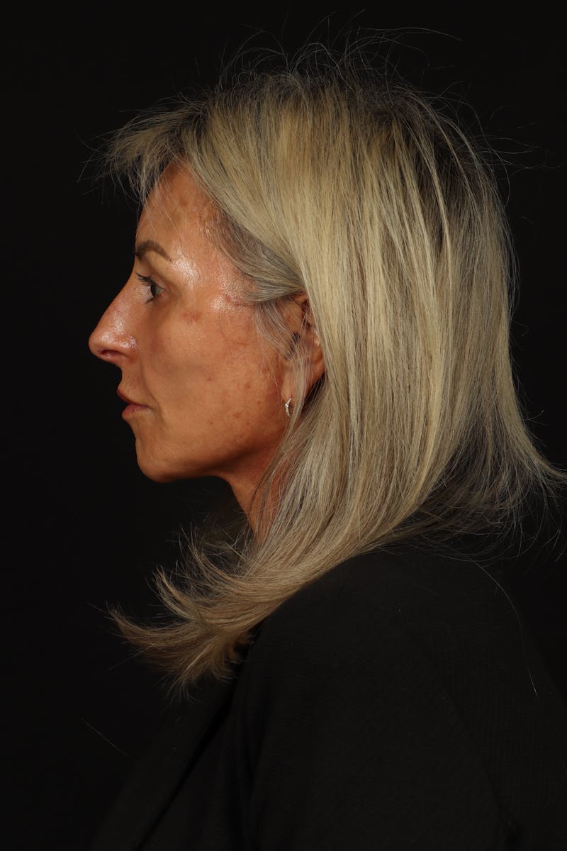 Facelift Before & After Gallery - Patient 246283 - Image 6
