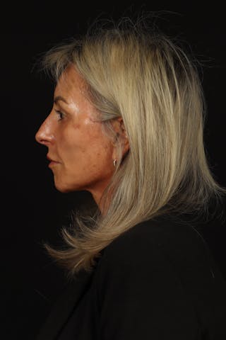 Facelift Before & After Gallery - Patient 246283 - Image 6